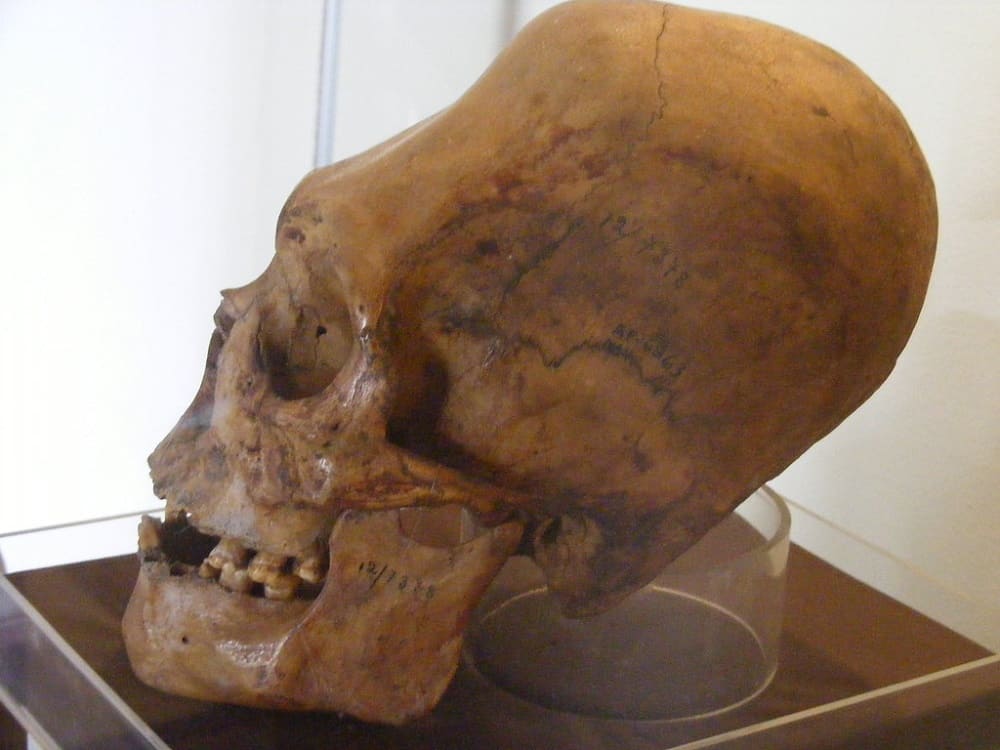 Cranial deformations